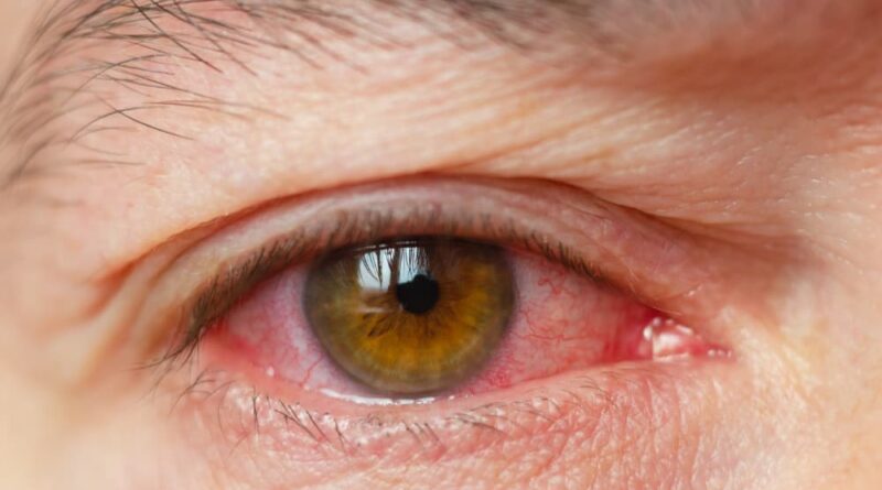 Sinais de alergias oculares que você precisa conhecer